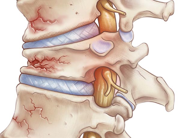 Osteoporosis