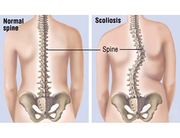 Scoliosis