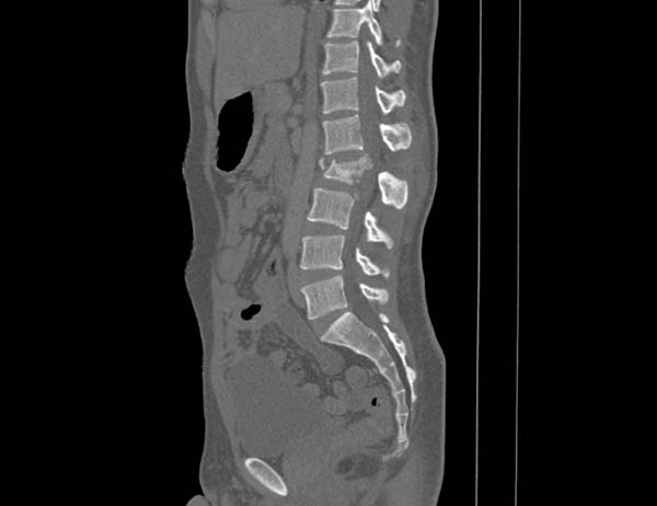 Spinal Fracture