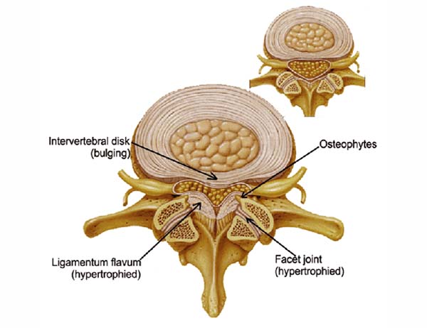 Spinal Stenosis