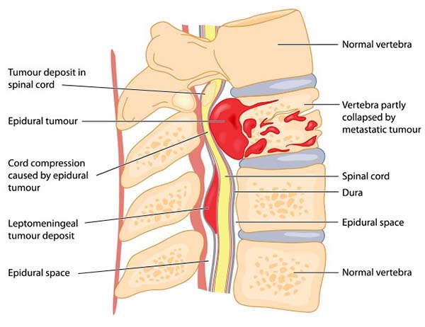 Spinal Tumours
