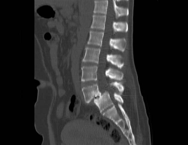 Spondylolisthesis