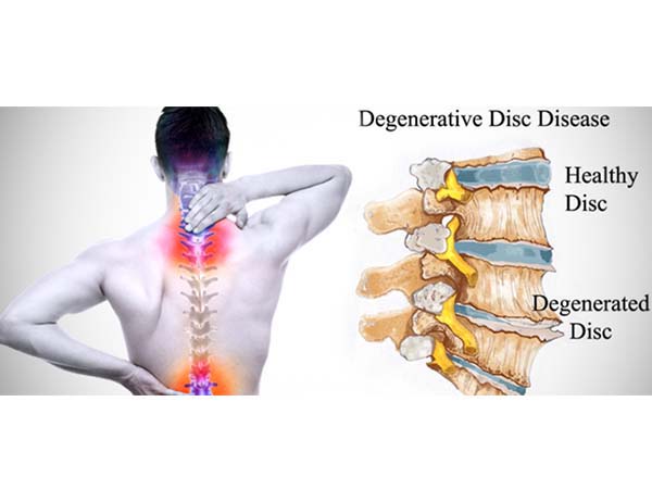 Degenerative Disc Disease