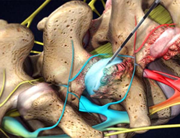 Picture of Facet Joint