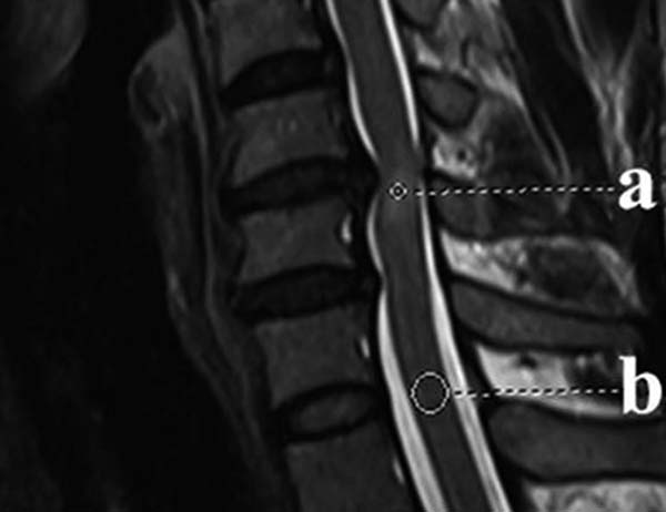 Myelopathy