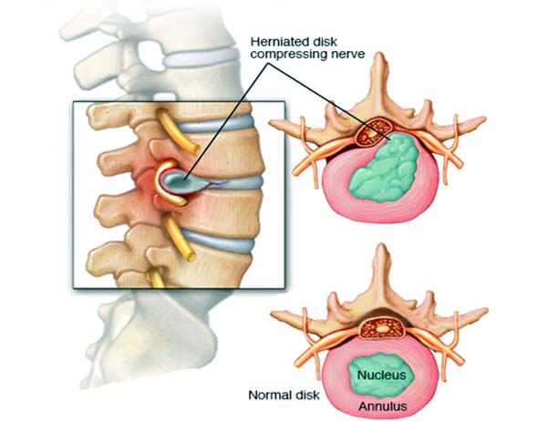 Picture of Herniated Disc